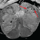 A high-resolution scan of a covid-19 patient’s brain stem. The arrows point to light and dark spots that suggest blood vessel damage.